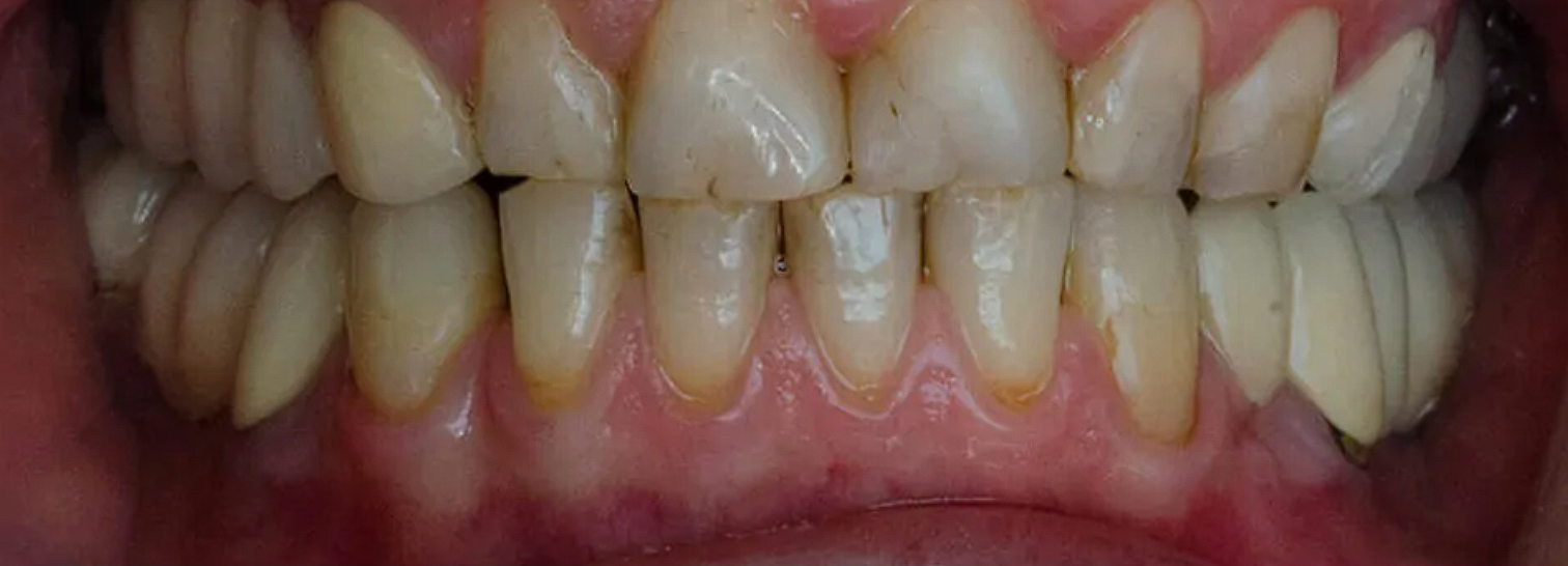 Înainte — Coroane ceramice