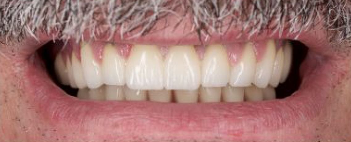 După — Implant dentar