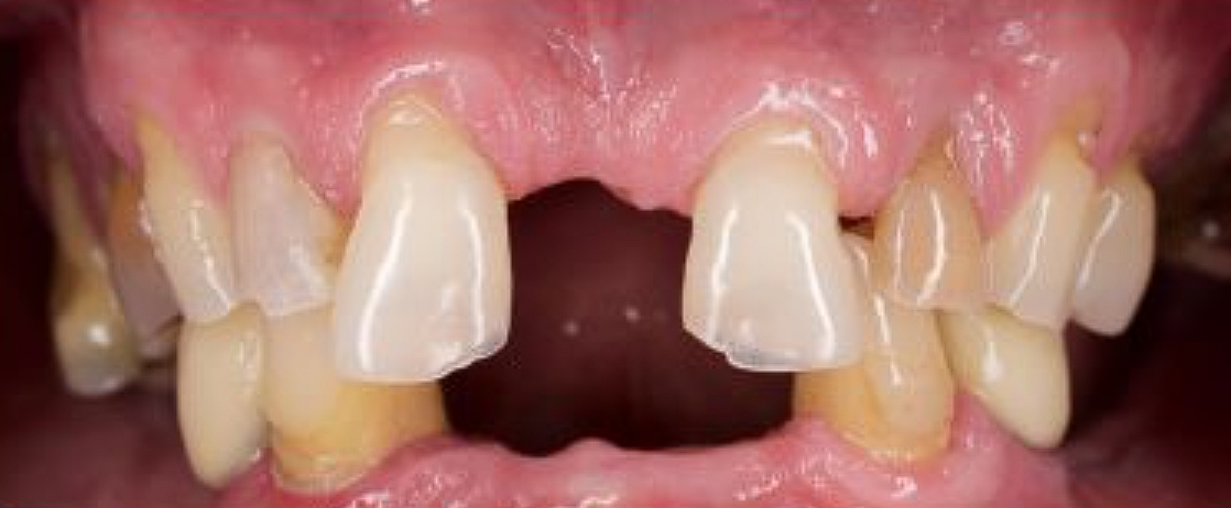 Înainte — Implant dentar
